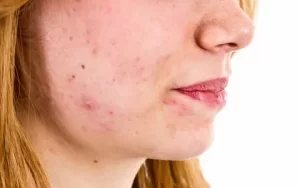 Top 8 Lessons About Fungal Acne To Learn Before You Hit 30