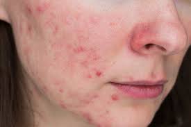 Top 8 Lessons About Fungal Acne To Learn Before You Hit 30